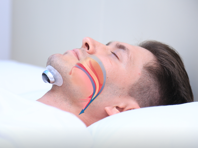 SilentEase Anti-Snoring Device – Smart Pulse Technology for Restful Sleep